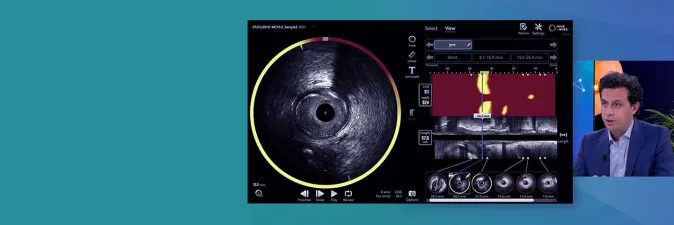 benefits of IVUS