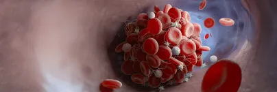 Avantec Vascular